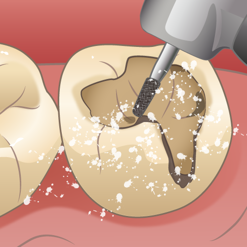 学園都市(神戸市西区)の歯医者、幸田歯科医院のむし歯治療