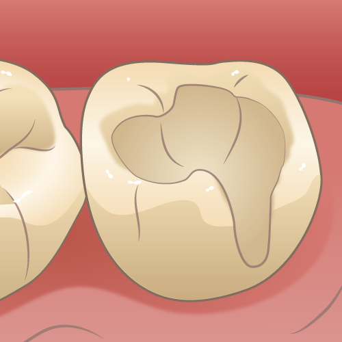 学園都市(神戸市西区)の歯医者、幸田歯科医院のむし歯治療