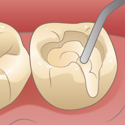 学園都市(神戸市西区)の歯医者、幸田歯科医院のむし歯治療