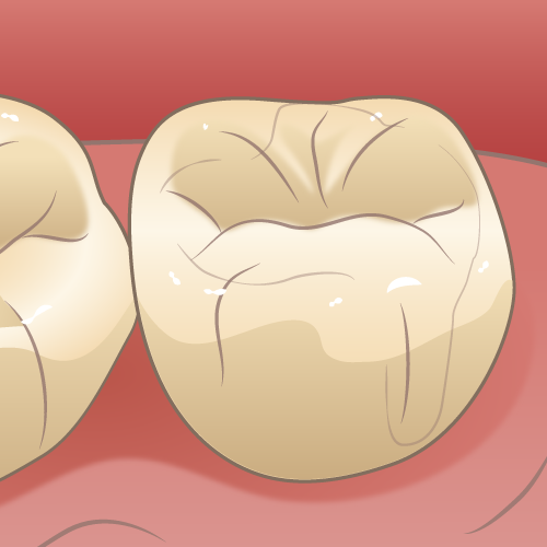 学園都市(神戸市西区)の歯医者、幸田歯科医院のむし歯治療