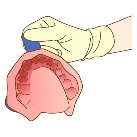 学園都市(神戸市西区)の歯医者、幸田歯科医院のむし歯治療