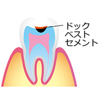 学園都市(神戸市西区)の歯医者、幸田歯科医院のむし歯治療