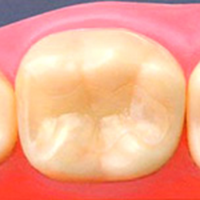 学園都市(神戸市西区)の歯医者、幸田歯科医院のむし歯治療