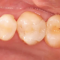 学園都市(神戸市西区)の歯医者、幸田歯科医院のむし歯治療