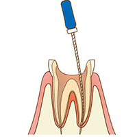 学園都市(神戸市西区)の歯医者、幸田歯科医院のむし歯治療