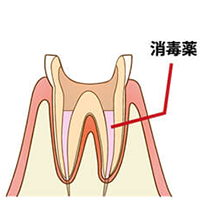 学園都市(神戸市西区)の歯医者、幸田歯科医院のむし歯治療