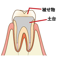 学園都市(神戸市西区)の歯医者、幸田歯科医院のむし歯治療