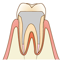 学園都市(神戸市西区)の歯医者、幸田歯科医院のむし歯治療