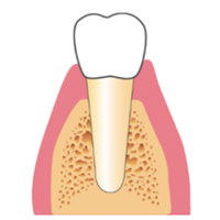 学園都市(神戸市西区)の歯医者、幸田歯科医院のむし歯治療