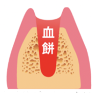 学園都市(神戸市西区)の歯医者、幸田歯科医院のむし歯治療