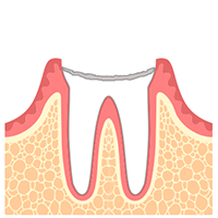 学園都市(神戸市西区)の歯医者、幸田歯科医院のむし歯治療