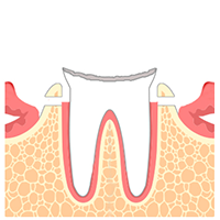 学園都市(神戸市西区)の歯医者、幸田歯科医院のむし歯治療