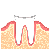 学園都市(神戸市西区)の歯医者、幸田歯科医院のむし歯治療