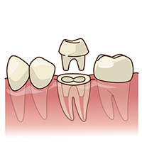 学園都市(神戸市西区)の歯医者、幸田歯科医院のむし歯治療